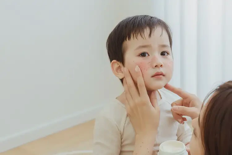 孩子臉上長濕疹可以徹底自愈嗎(圖3)