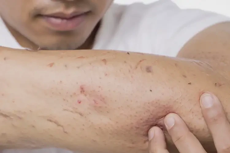青年人四肢容易長濕疹可以徹底自愈嗎(圖4)