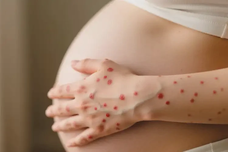 孕婦手上偶爾起濕疹可不可以徹底自愈(圖1)
