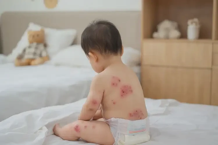 兒童屁股上經(jīng)常起濕疹能徹底自愈嗎(圖4)