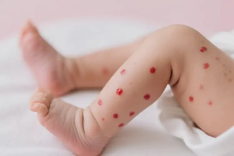 新生兒大腿上長濕疹不管它會自己好嗎(圖2)