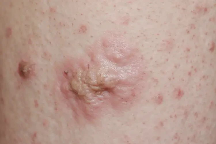 女人肛周有濕疹可不可以徹底自愈(圖4)