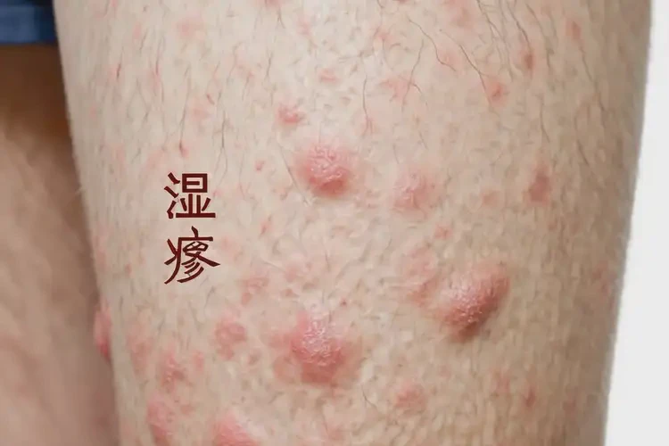 男性大腿長濕疹可以徹底自愈嗎(圖4)