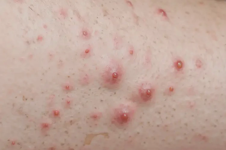 男人小腿上偶爾長(zhǎng)濕疹能不能徹底自愈(圖4)