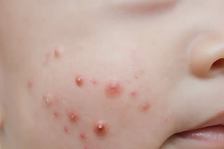 寶寶肛周長濕疹可以徹底自愈嗎(圖4)