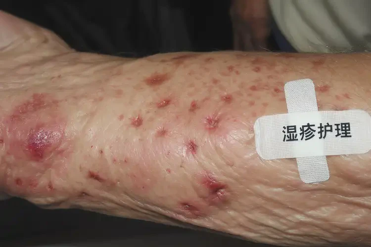 老人手臂有湿疹能靠自己自愈吗(图4)
