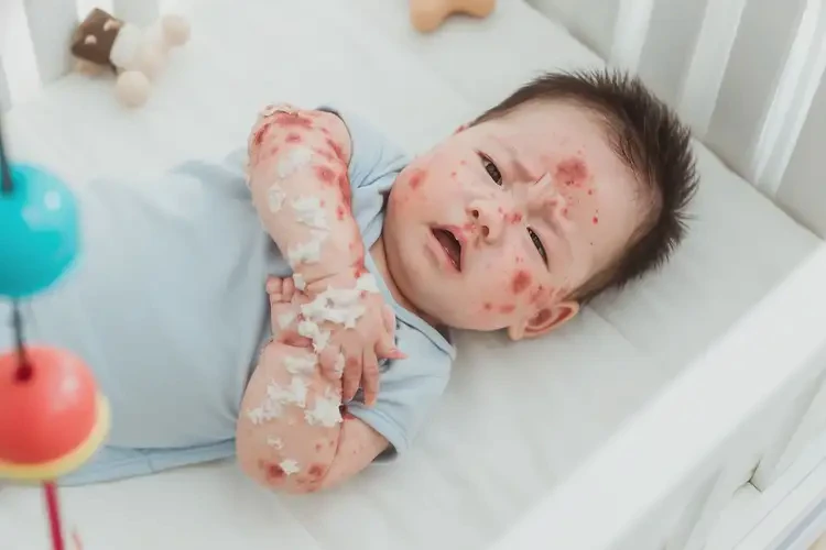 嬰兒全身容易長濕疹能靠自己自愈嗎(圖4)