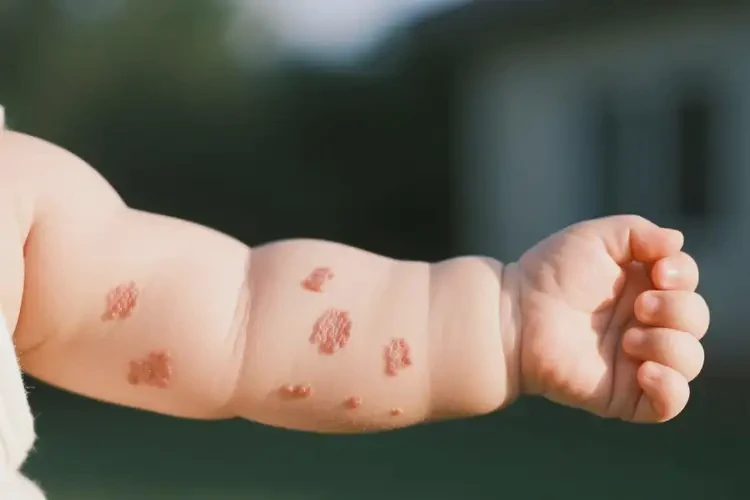 婴儿手臂出现湿疹不管它会自己好吗(图1)