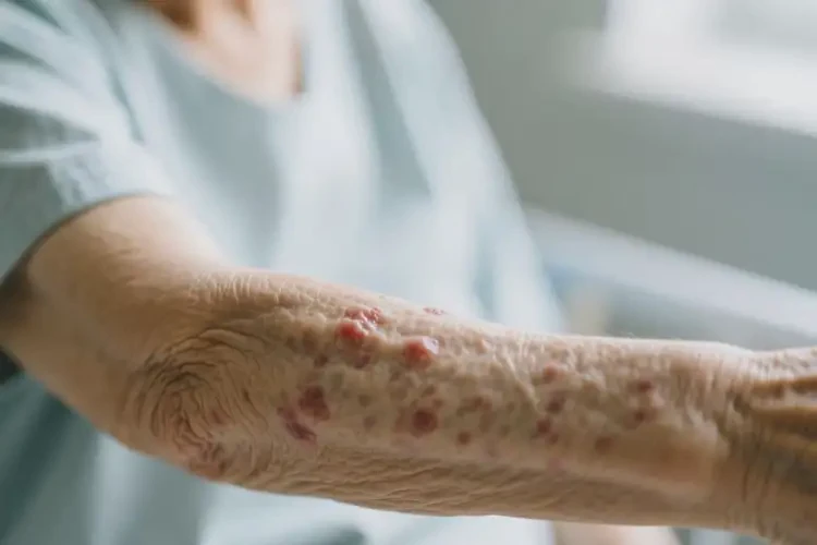 高齡老人手臂上出濕疹不管它會(huì)自己自愈嗎(圖4)