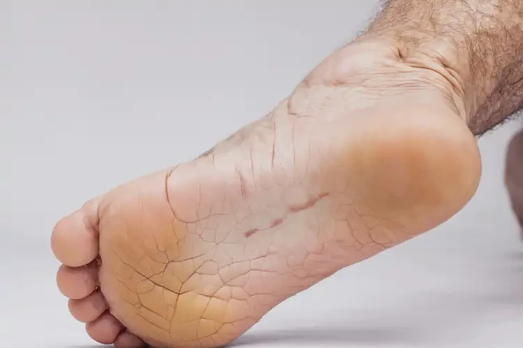 老年人腳上出現(xiàn)濕疹可不可以徹底自愈(圖2)