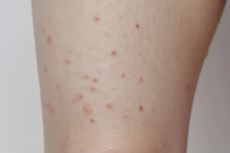 小孩大腿上偶爾長(zhǎng)濕疹不管它會(huì)自己好嗎(圖4)