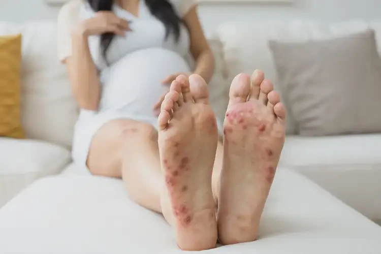 孕婦腳上偶爾起濕疹不管它會自己好嗎(圖4)