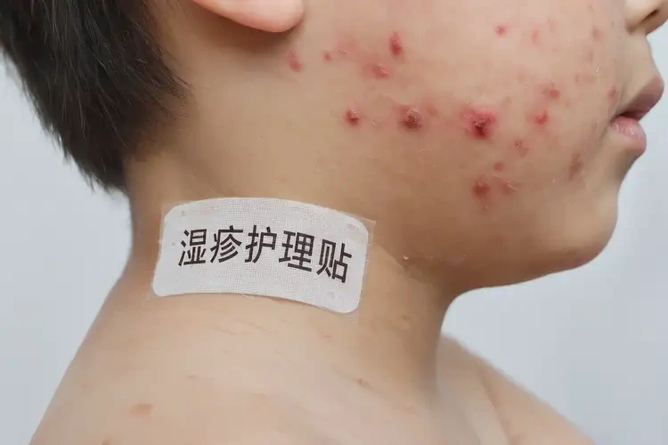 青少年脖子容易起濕疹能徹底自愈嗎(圖4)