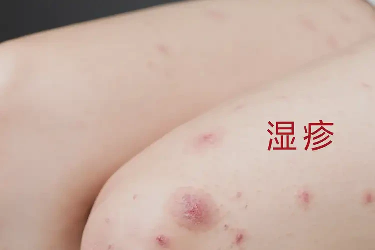 女生大腿長(zhǎng)濕疹能靠自己自愈嗎(圖4)