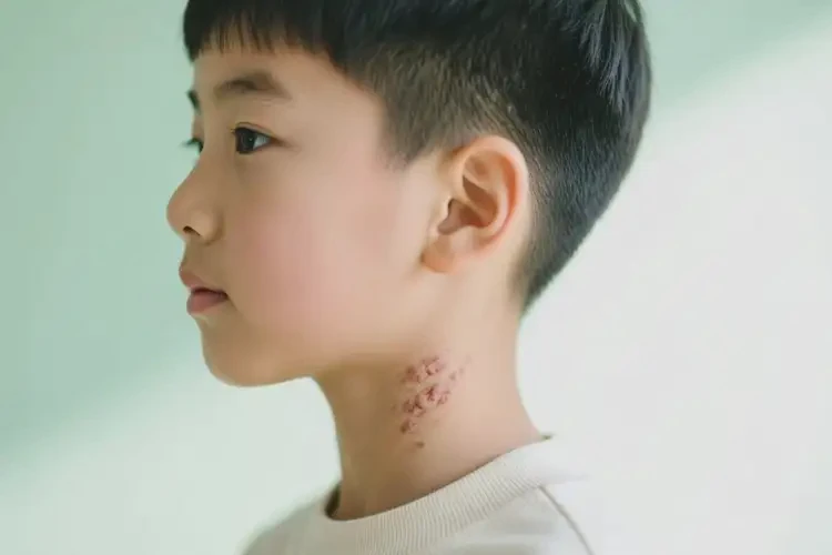 小學(xué)生脖子經(jīng)常起濕疹可以徹底自愈嗎(圖3)