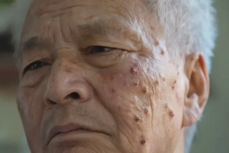 老人臉上偶爾起濕疹能徹底自愈嗎(圖4)