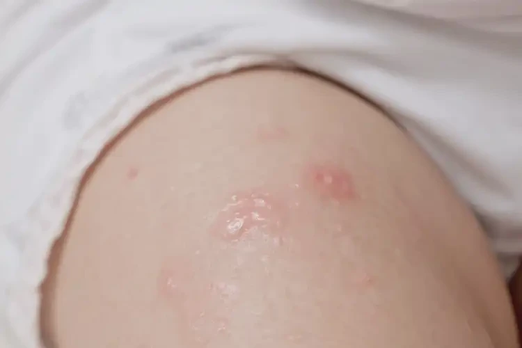 嬰幼兒大腿上容易長濕疹可不可以徹底自愈(圖4)