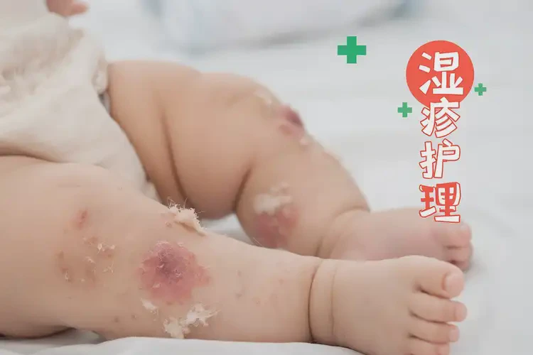嬰幼兒小腿上容易起濕疹不管它會自己好嗎(圖4)
