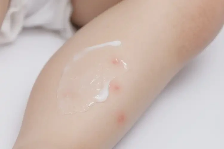 兒童小腿經(jīng)常起濕疹不管它會自己痊愈嗎(圖3)