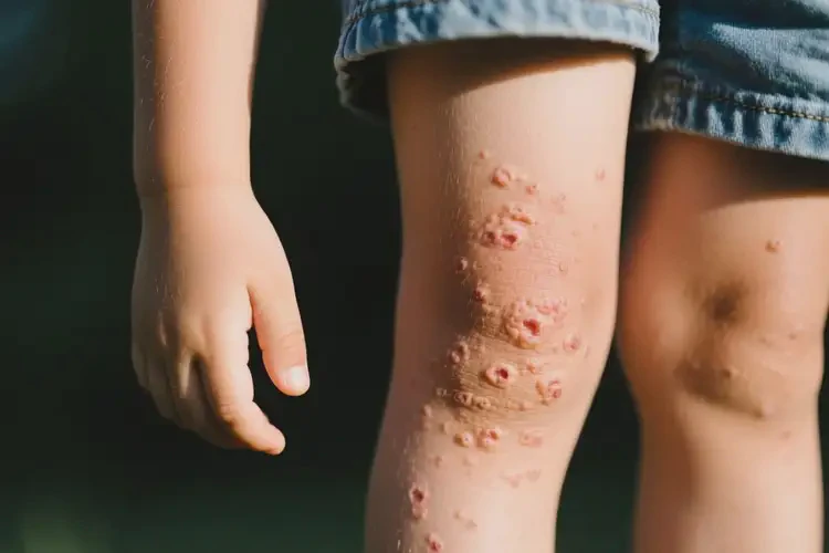 孩子四肢容易起濕疹不管它會(huì)自己自愈嗎(圖1)