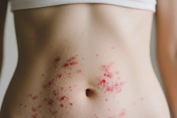 女人肚子偶爾長濕疹不管它會自己好嗎(圖2)