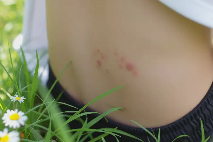 男生屁股有湿疹可不可以彻底自愈(图2)