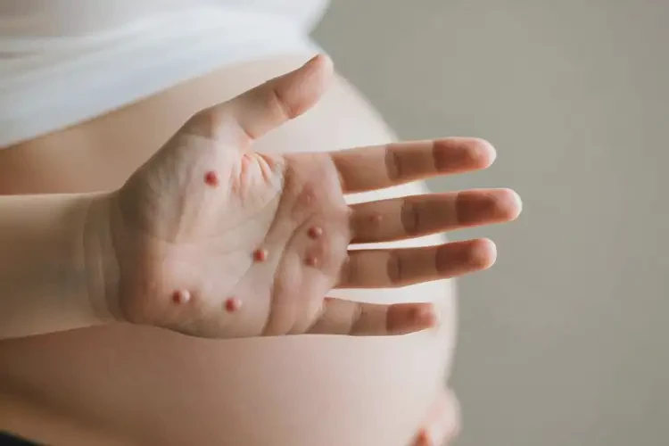 孕婦手上偶爾起濕疹可不可以徹底自愈(圖2)
