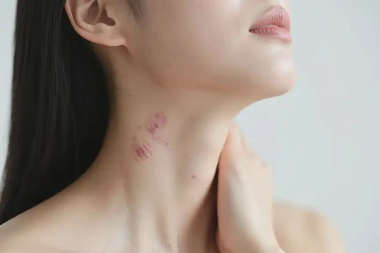 女人脖子偶爾起濕疹不管它會(huì)自己好嗎(圖1)