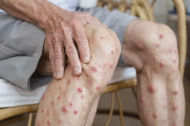 老年人大腿上偶爾長濕疹能夠徹底治愈嗎(圖3)