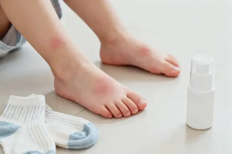 小孩脚上有湿疹能靠自己自愈吗(图3)