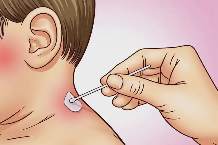 小兒脖子上長(zhǎng)濕疹能夠徹底治愈嗎(圖3)