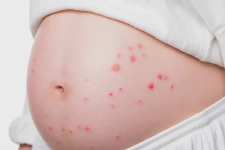 產(chǎn)婦肚子偶爾起濕疹能靠自己自愈嗎(圖2)
