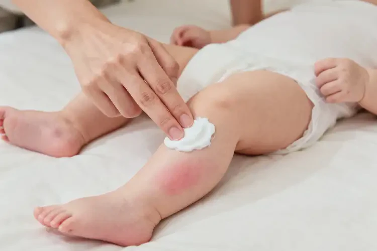 新生兒小腿上偶爾長(zhǎng)濕疹能靠自己自愈嗎(圖1)