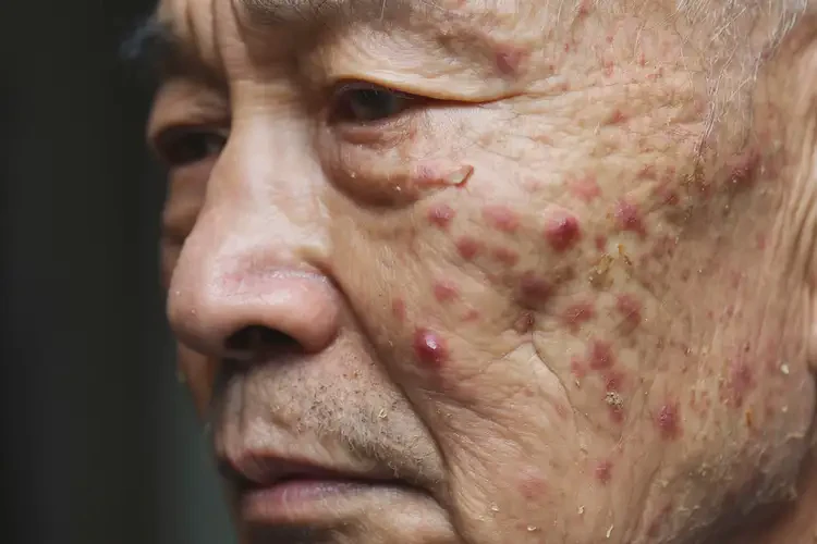 老年人臉上容易長(zhǎng)濕疹不管它會(huì)自己好嗎(圖4)
