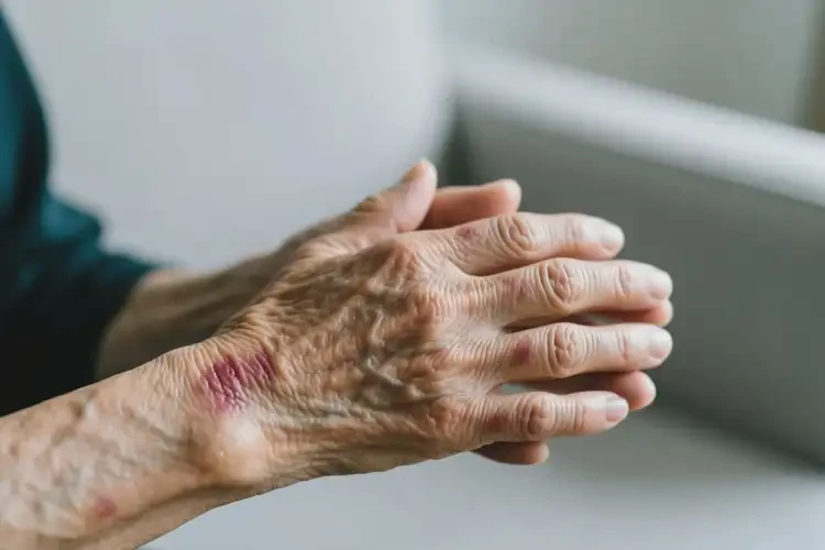 老年人四肢偶爾長濕疹不管它會自己自愈嗎(圖2)