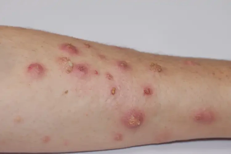 男人屁股偶爾起濕疹不管它會自己好嗎(圖4)