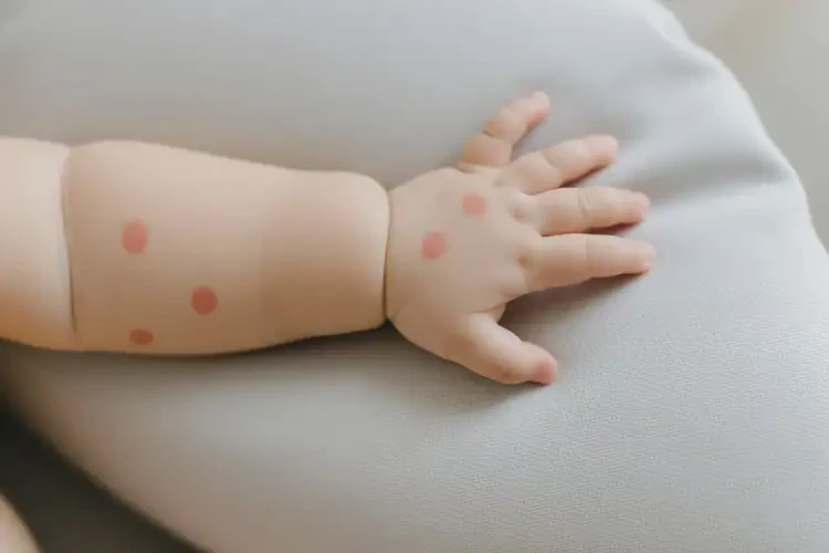 嬰兒手臂偶爾長濕疹能夠徹底治愈嗎