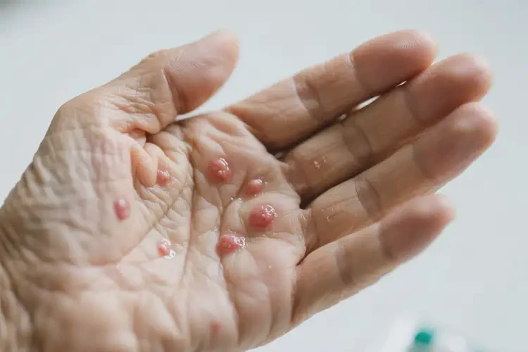 高齡老人手上偶爾長濕疹不管它會自己自愈嗎(圖3)