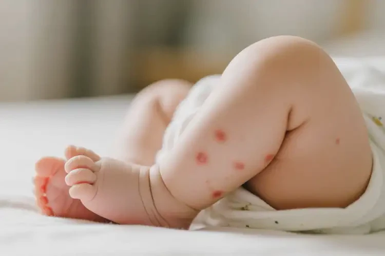 嬰兒小腿偶爾起濕疹能夠徹底治愈嗎(圖3)