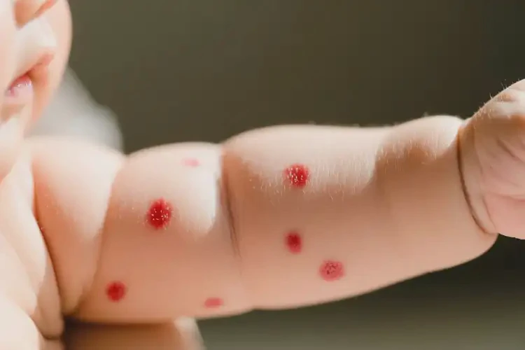 嬰幼兒手臂偶爾長濕疹不管它會(huì)自己好嗎(圖1)