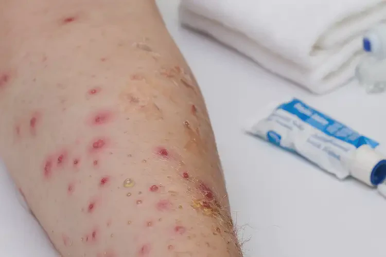 中学生屁股上容易起湿疹能不能彻底自愈(图3)