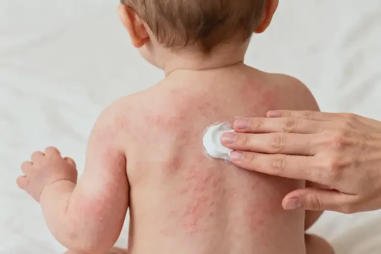 嬰兒全身容易長(zhǎng)濕疹不管它會(huì)自己痊愈嗎(圖3)