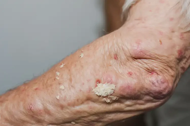 高齡老人手臂有濕疹不管它會自己好嗎(圖4)