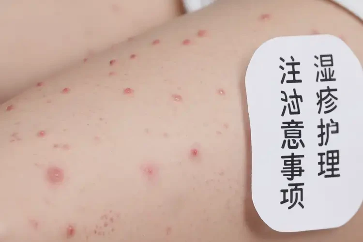 少兒大腿上偶爾長(zhǎng)濕疹不管它會(huì)自己痊愈嗎(圖4)