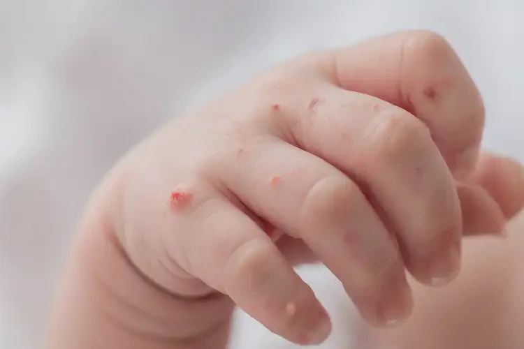 新生兒手上起濕疹不管它會(huì)自己痊愈嗎(圖4)