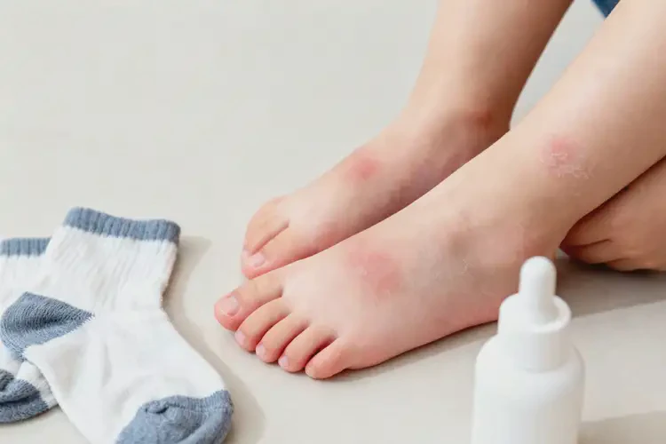 小孩脚上有湿疹能靠自己自愈吗(图1)