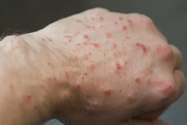 男人手上偶爾起濕疹可不可以徹底自愈(圖4)