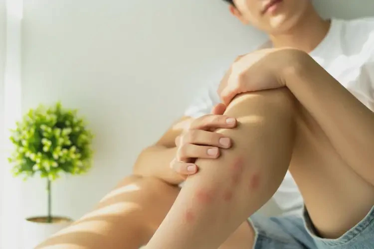 青年人大腿上起濕疹可不可以徹底自愈(圖3)