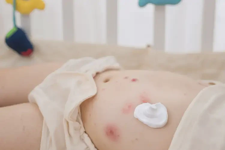 幼兒肚子偶爾起濕疹不管它會自己痊愈嗎(圖1)