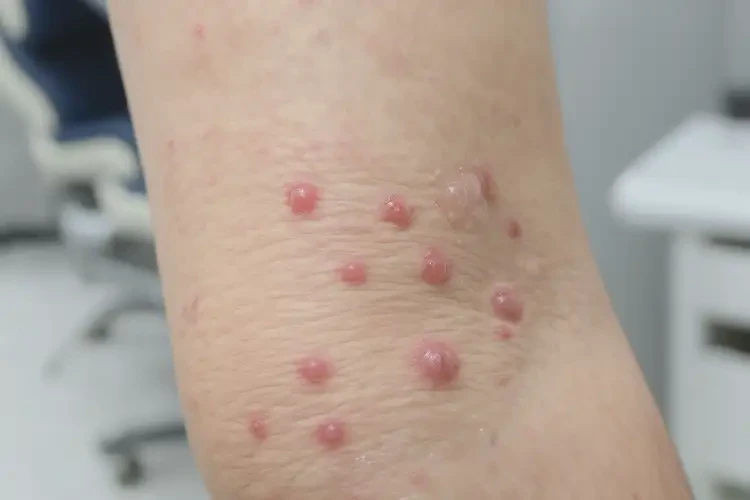 女生肛周容易长湿疹不管它会自己痊愈吗(图3)